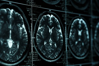 Brain scan imaging